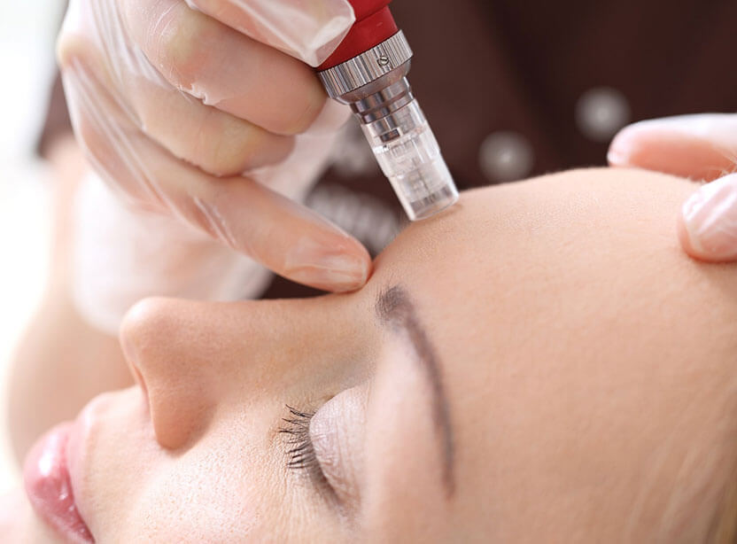 Microneedling